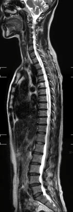MRIで撮影した脊椎画像