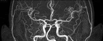 3.0テスラMRIで撮影した脳動脈画像