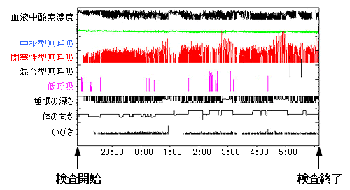 終夜ポリソムノグラフィー検査 all Night画面