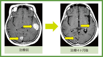 転移性脳腫瘍 治療症例