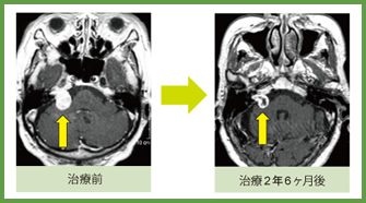 聴神経鞘腫 治療症例