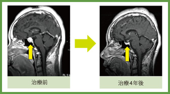 下垂体腺腫 治療症例