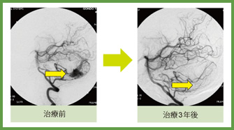 脳動静脈奇形 治療症例