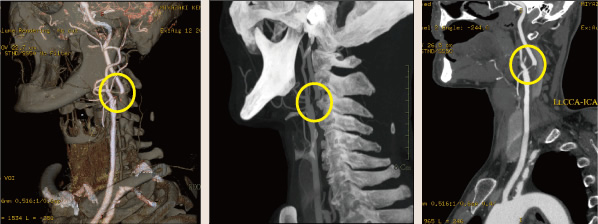 左内頚動脈高度狭窄症例