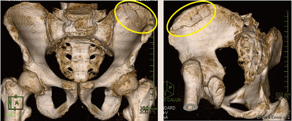 骨盤骨折症例