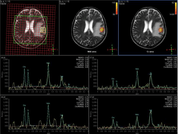 MRSでの脳の代謝画像