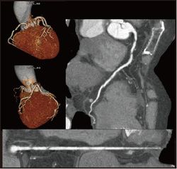 冠動脈CT画像