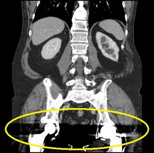 肺CT画像