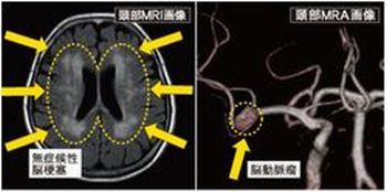 頭部MRI・MRA画像