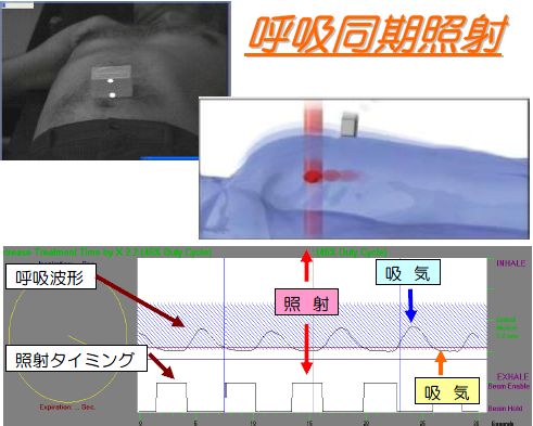 呼吸同期照射