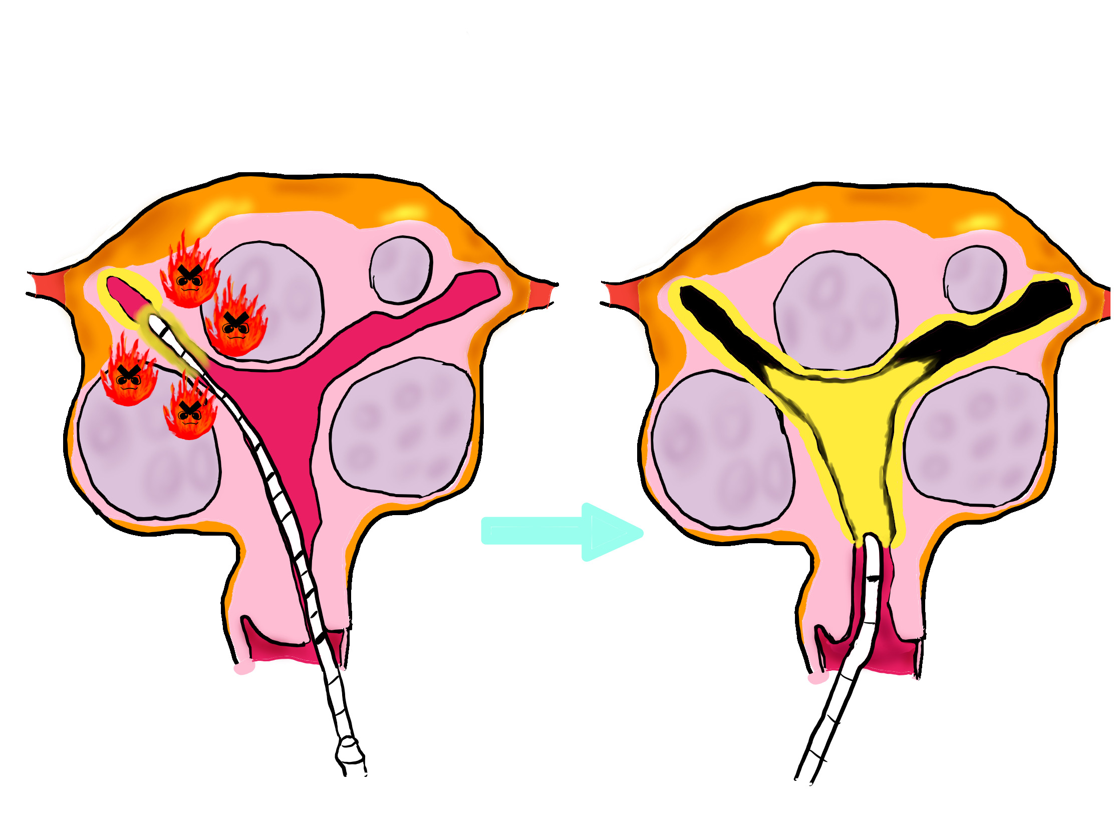 ポリープ 管 子宮 頚