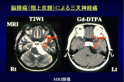 脳腫瘍（類上皮腫）による三叉神経痛