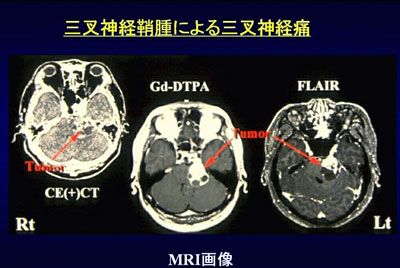 三叉神経鞘腫による三叉神経痛