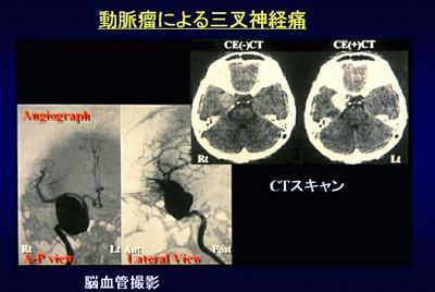 動脈瘤による三叉神経痛