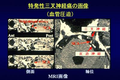 特発性三叉神経痛の画像（血管圧迫）