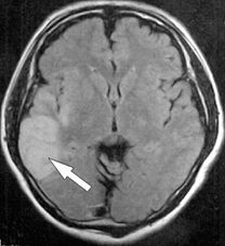 写真1：MRI-脳梗塞