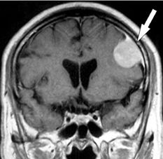 写真4：MRI-髄膜腫