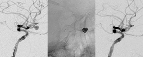 脳動脈瘤に対する血管内手術施行例