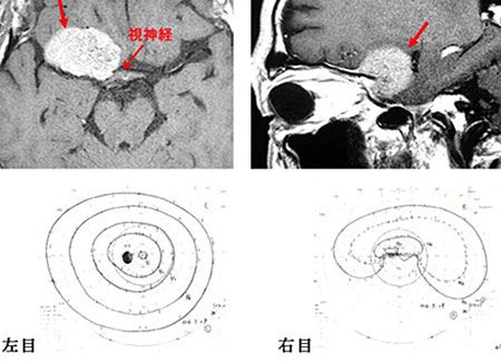 脳動脈瘤に対する血管内手術施行例