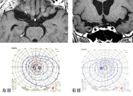 脳動脈瘤に対する血管内手術施行例