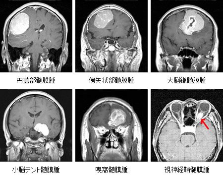 脳動脈瘤に対する血管内手術施行例