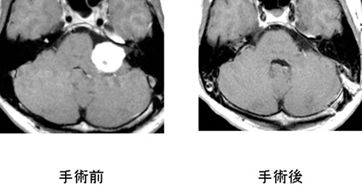 脳動脈瘤に対する血管内手術施行例