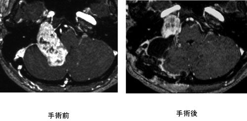 脳動脈瘤に対する血管内手術施行例