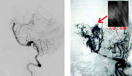【正常の椎骨動脈造影(左)ともやもや病の椎骨動脈造影(右)】