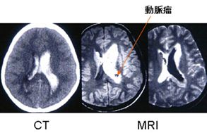 【もやもや病によって起こった脳室内出血】