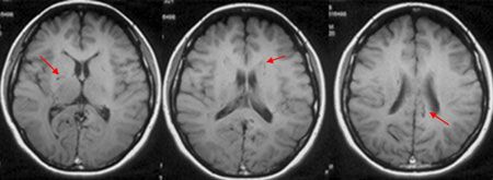 【もやもや病のMRI画像　（下から見た像）　　もやもや血管（矢印）がみえる】