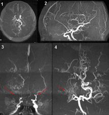 【1：下から見た像　2：左横から見た像】<br />【3：内頚動脈系 正面像　　4：椎骨脳底動脈系 正面像】