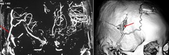 【3DCT画像　バイパス術後、右浅側頭動脈（矢印）を頭蓋内へつないだ】